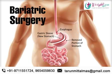 Weight lose Surgery - Will It Really Work for You?