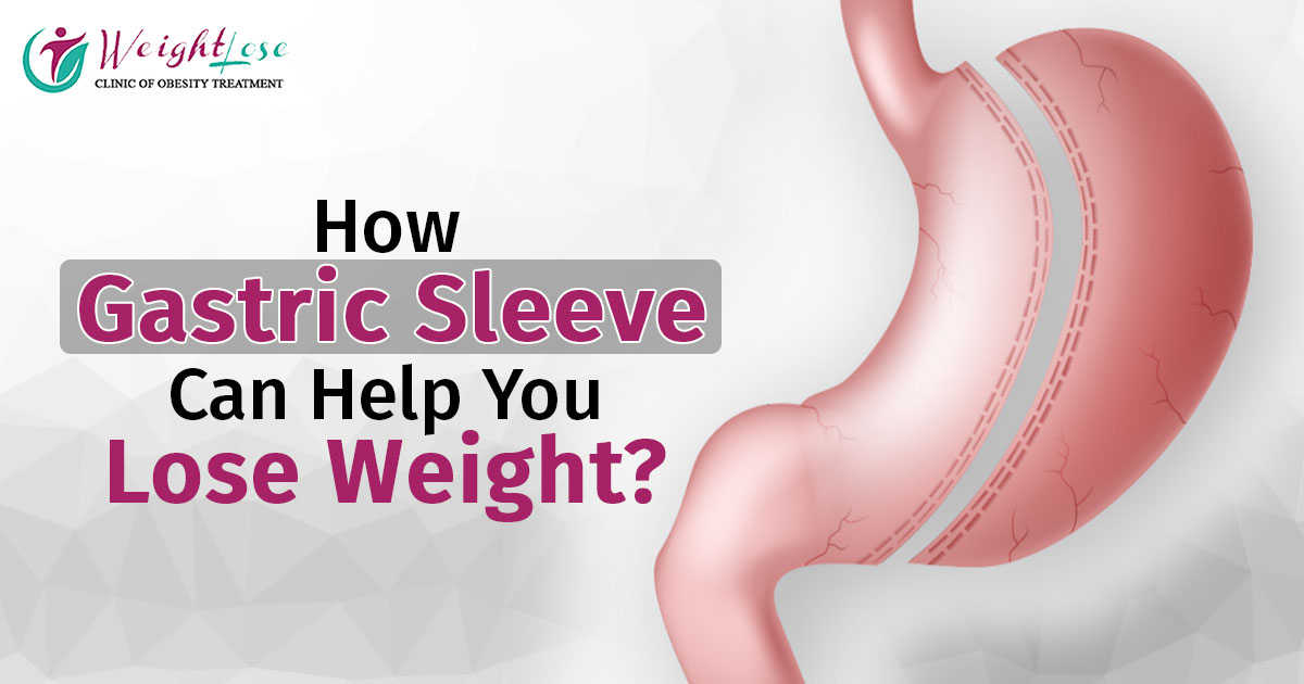 How Gastric Sleeve Can Help You Lose Weight?