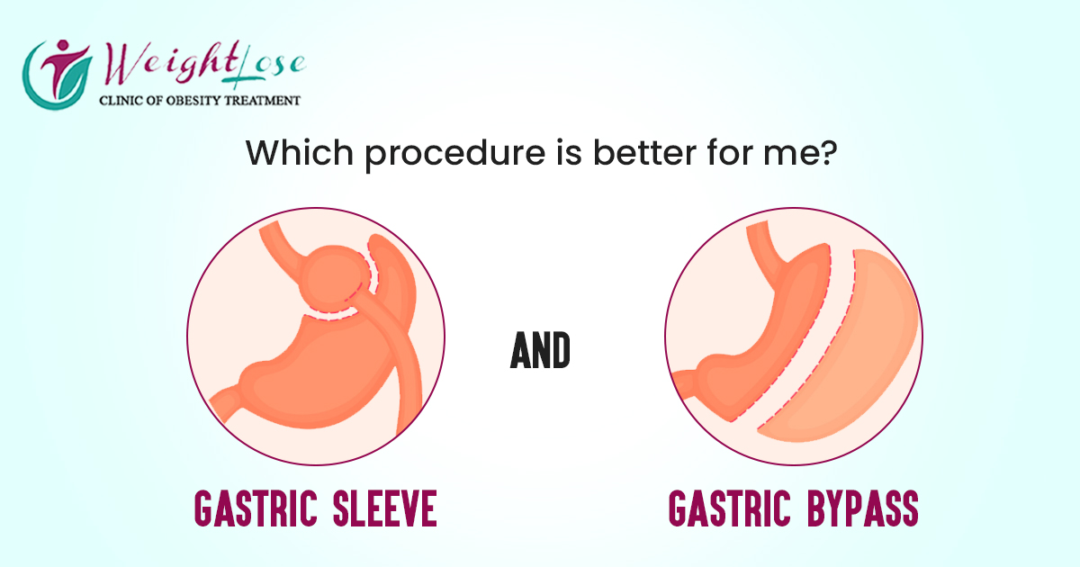 Gastric Sleeve or Gastric Bypass: Which procedure is better for me