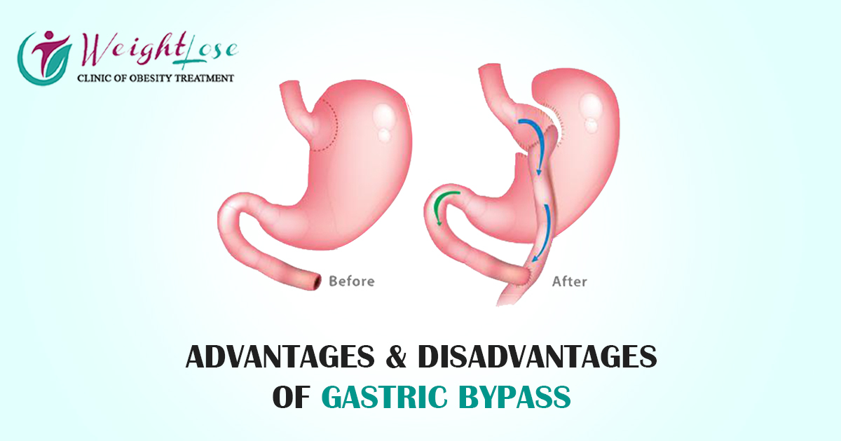 ADVANTAGES & DISADVANTAGES OF GASTRIC BYPASS