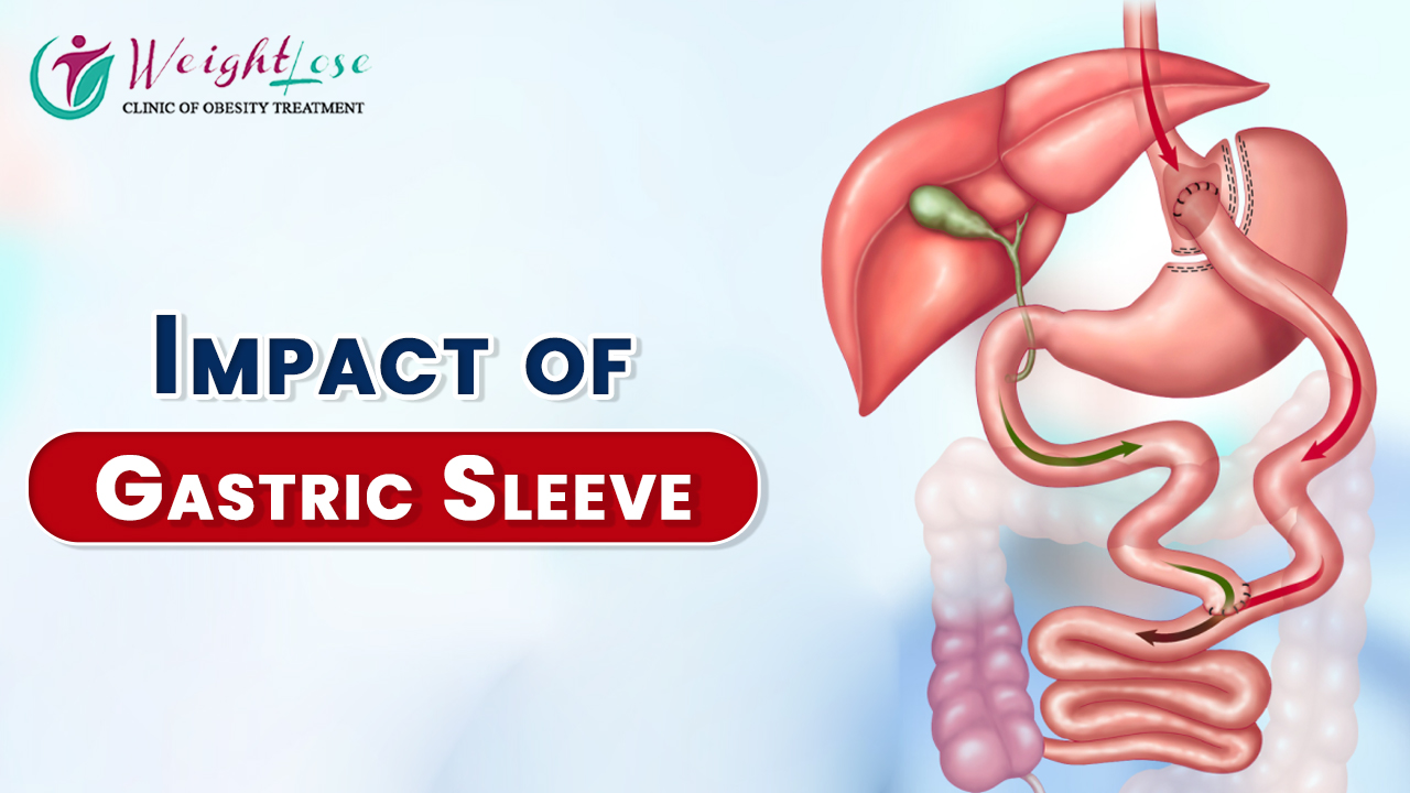 Impact of Gastric Sleeve