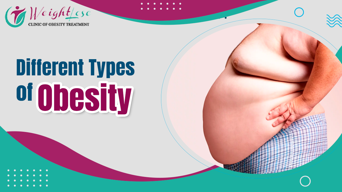 Different Types of Obesity