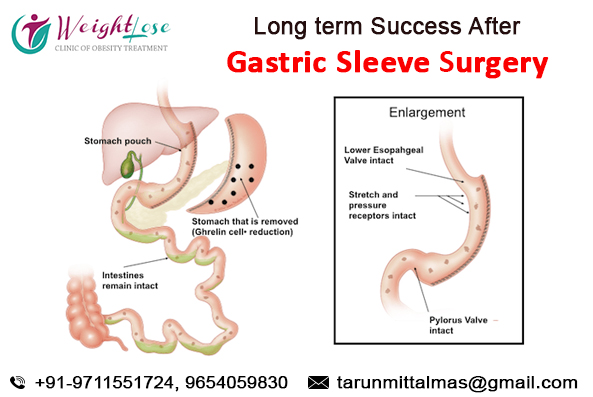 Look Good, Feel Better and Be the Best Advantages of Sleeve Gastrectomy