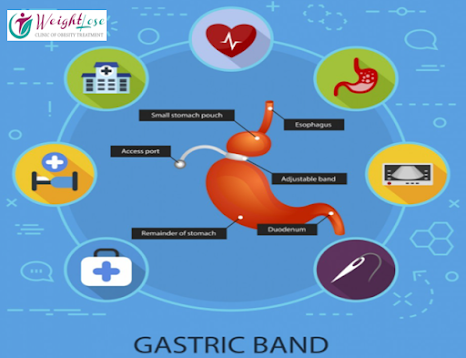 Advantages of Gastric Banding Surgery
