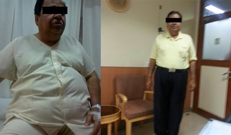 Best Bariatric Surgery Center in Delhi NCR